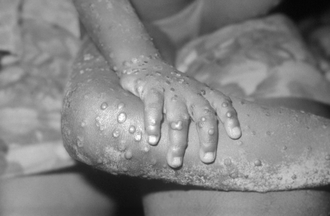 Child in Liberia with monkeypox 1971. Image: CDCP. US Dept Health & Human Services