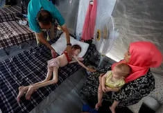 Scenes of severe malnutrition in Gaza
